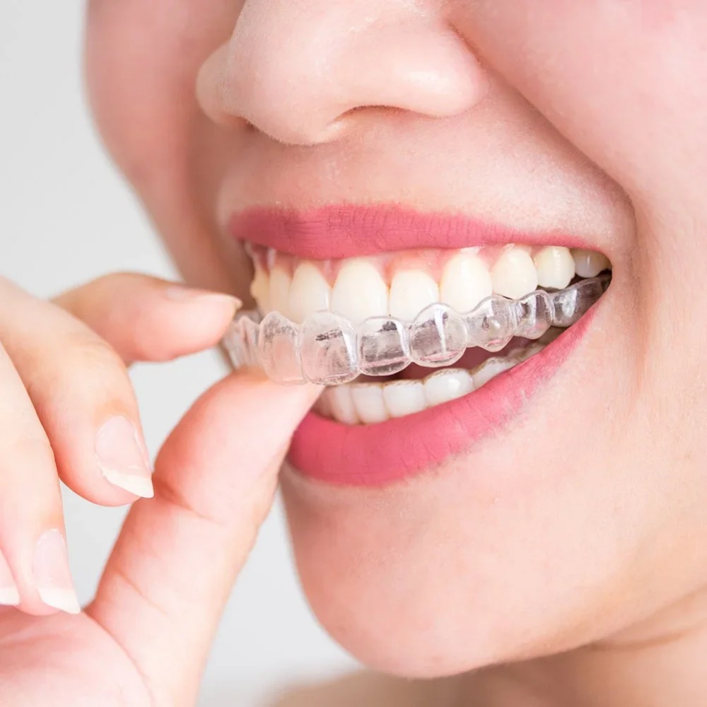 Teeth Whitening Mouth Guard - 1-4個入りいびき防止歯ぎしり防止睡眠用マウスガードトレイ、歯ぎしり防止睡眠補助ナイトガード、歯茎保護マウスヘルスケアツール