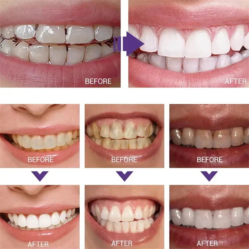 歯のクリーニング ホワイトニング歯磨き粉 ホワイトニングジェ - Teeth Whitening Korea のレビューと価格