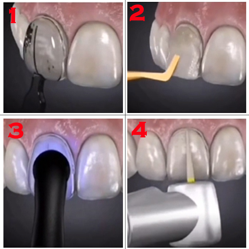 歯科用型取り金型 コンポジットレジンベニア用 光硬化充填 前 - Teeth Whitening Lab のレビューと価格