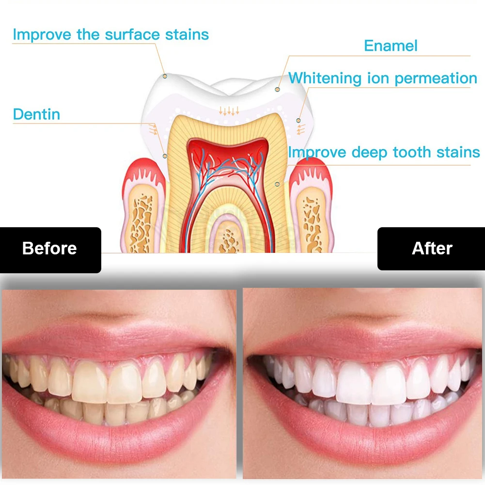歯科歯ホワイトニングキットミニ 16 LED コールドライト - Teeth Whitening With Blue Light のレビューと価格