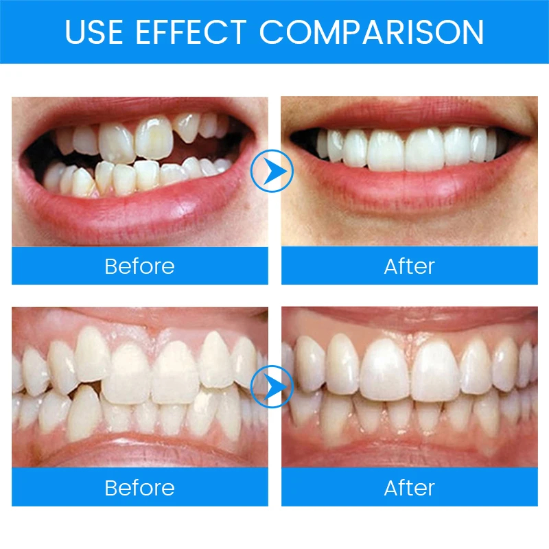 3 段階歯科矯正ブレース歯リテーナー歯ぎしりマウスガード歯矯 - Teeth Whitening Mouth Guard のレビューと価格